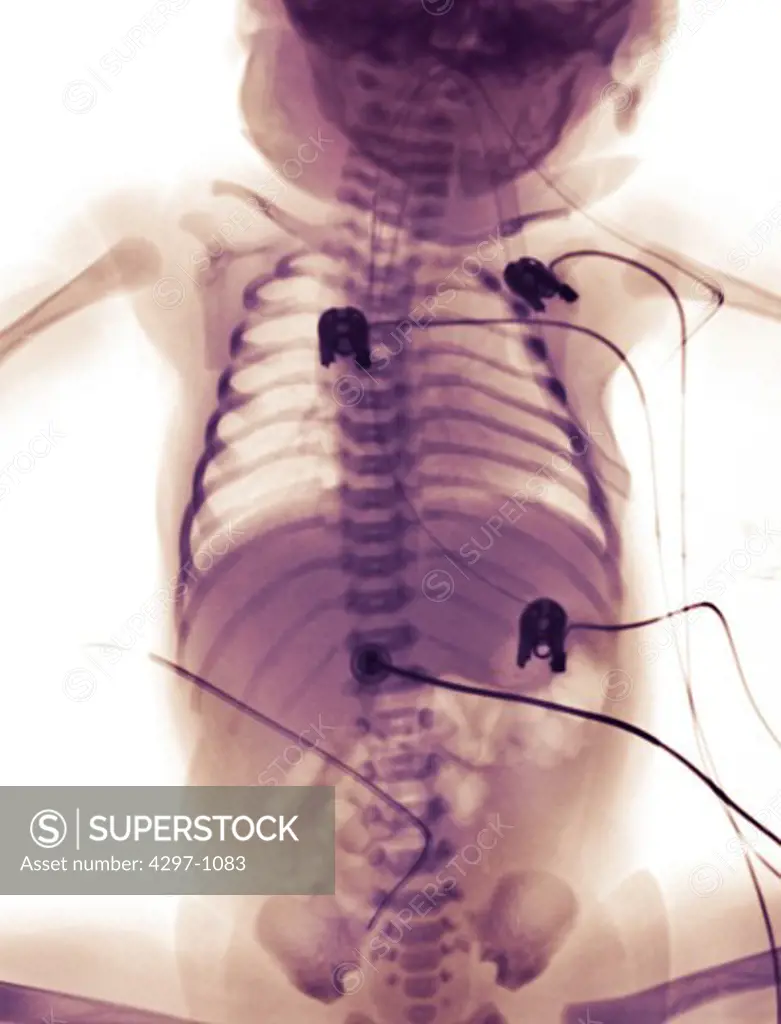X-ray of a newborn girl, with cardiac monitoring leads attached to her chest