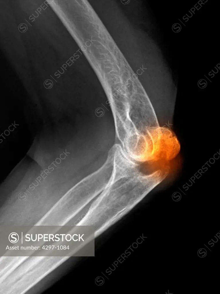 X-ray of an olecranon fracture in an 82 year old woman