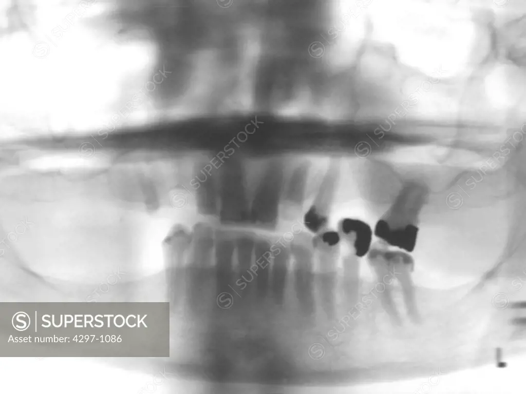 Panorex x-ray of the jaw of a 65 year old man showing dental fillings and missing teeth