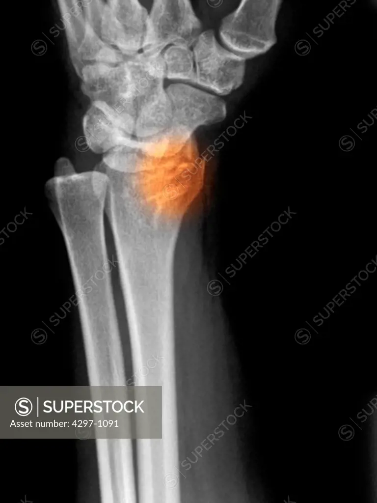 X-ray showing a distal radius fracture in a 52 year old woman