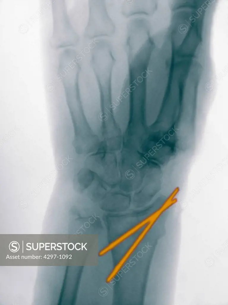X-ray of a radius fracture stabilized with two pins
