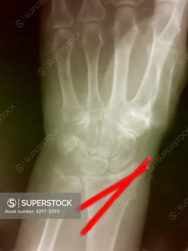 X-ray of a radius fracture stabilized with two pins