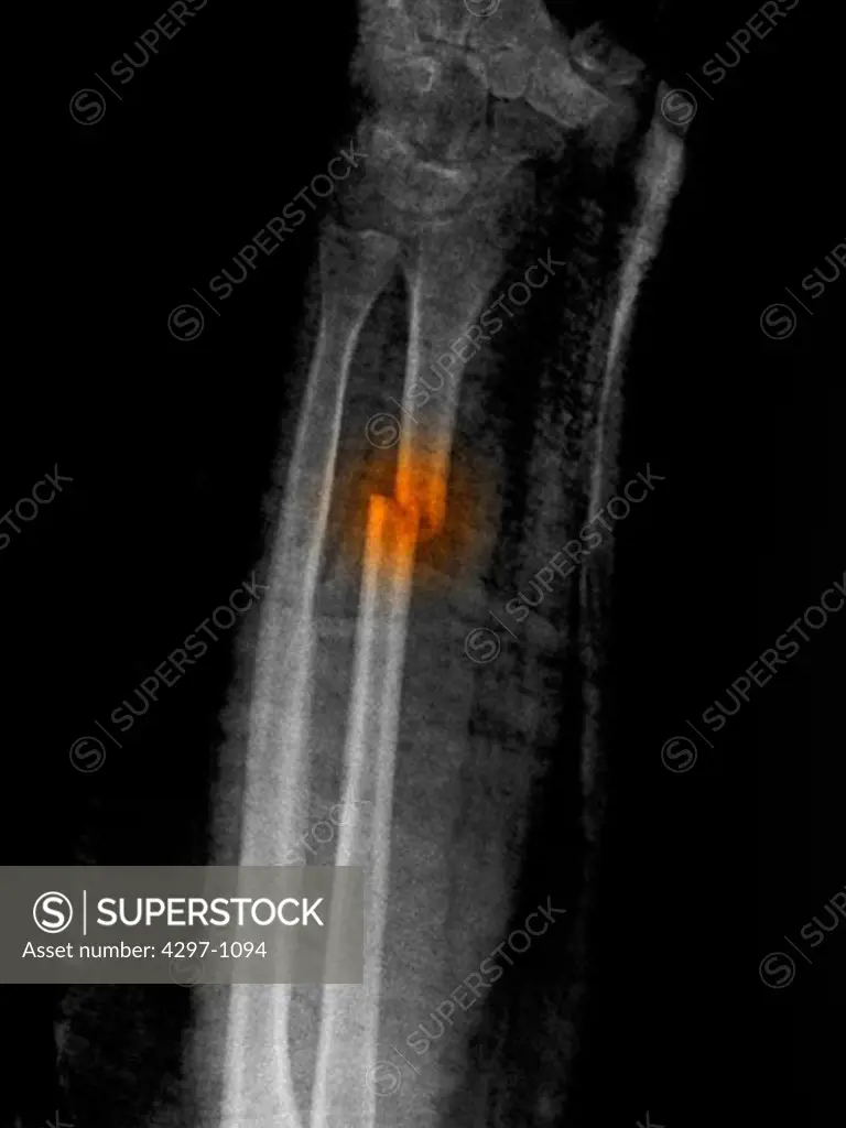 X-ray of a radius forearm fracture of a 52 year old woman