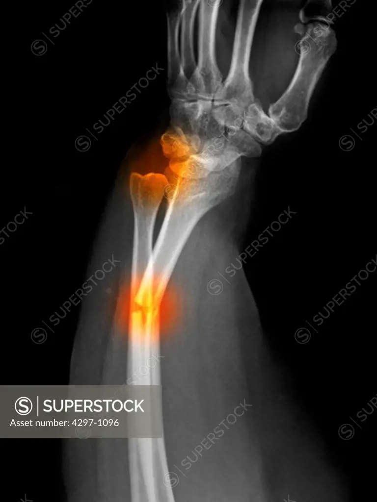 X-ray of a radius forearm fracture of a 52 year old woman with an associated wrist dislocation