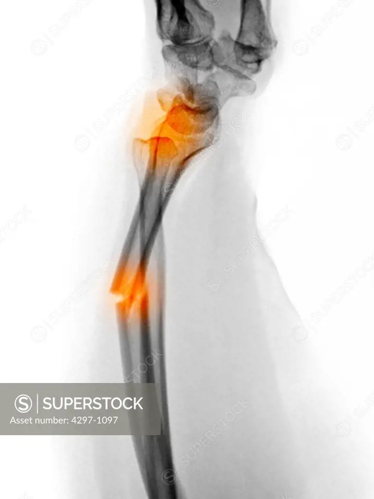 X-ray of a radius forearm fracture of a 52 year old woman with an associated wrist dislocation