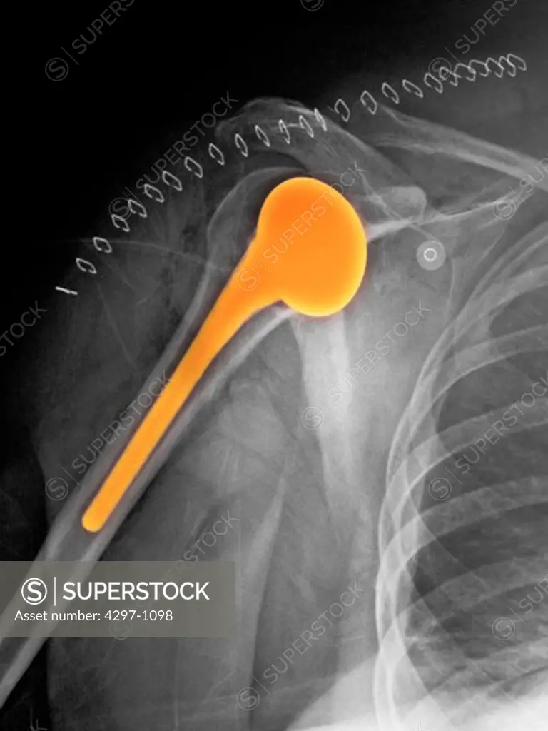 Shoulder replacement x-ray of a 51 year old woman