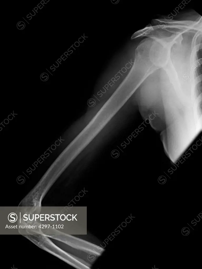 Normal shoulder x-ray of a 69 year old woman