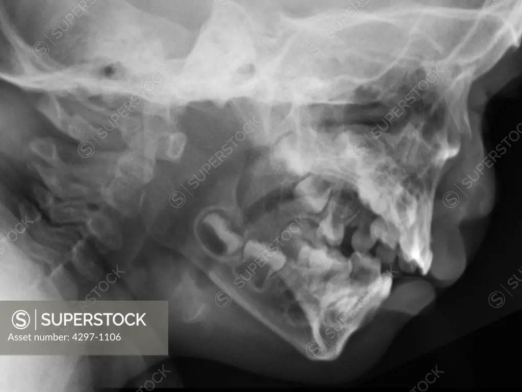 Normal lateral skull x-ray of a 2 year old boy