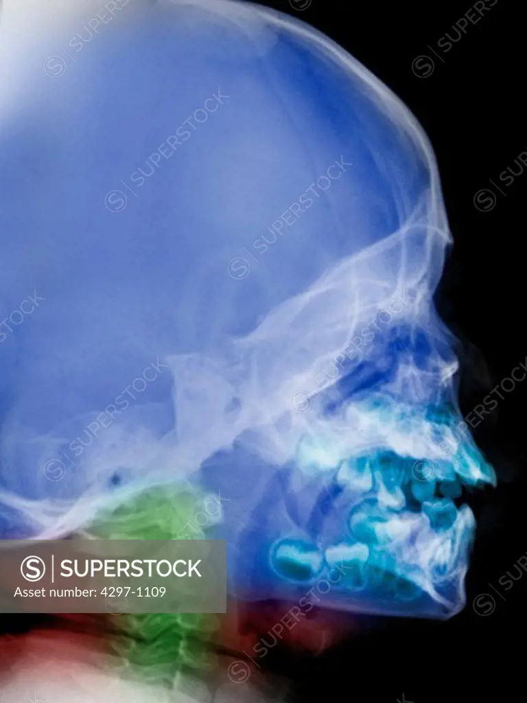 Normal lateral skull x-ray of a 2 year old boy