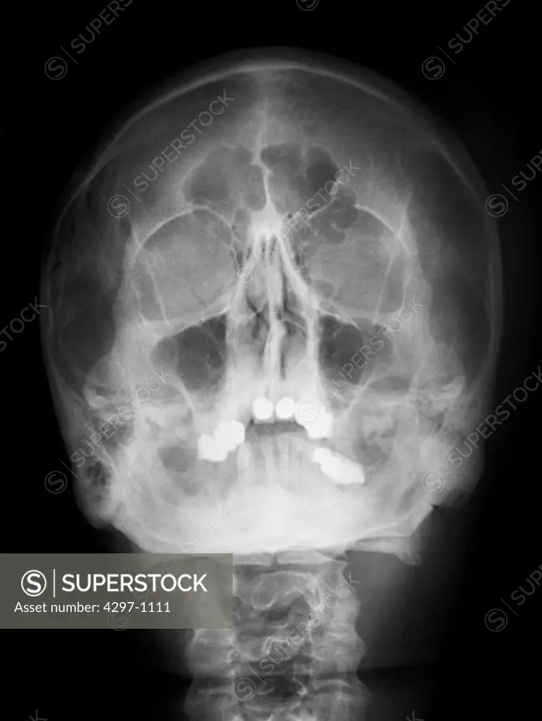 Skull x-ray of a 54 year old man with the maxillary and frontal sinuses highlighted
