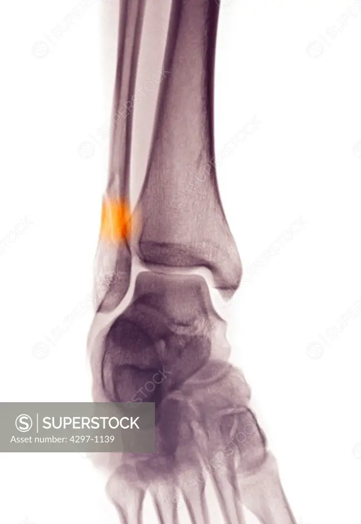 Colorized x-ray of the ankle of a 17 year old man showing a fractured distal fibula