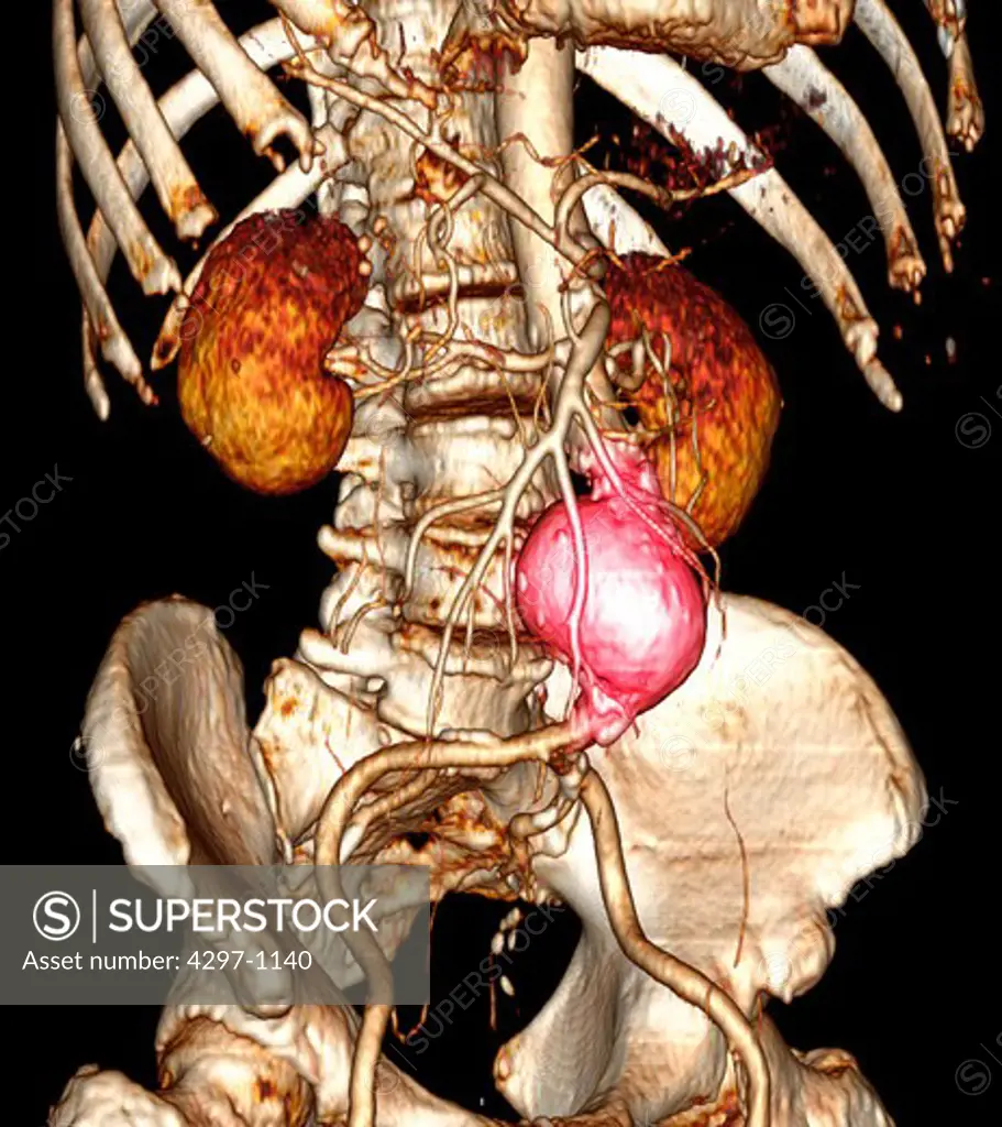 CT scan images showing an abdominal aortic aneurysm which developed between the renal arteries and the common iliac arteries