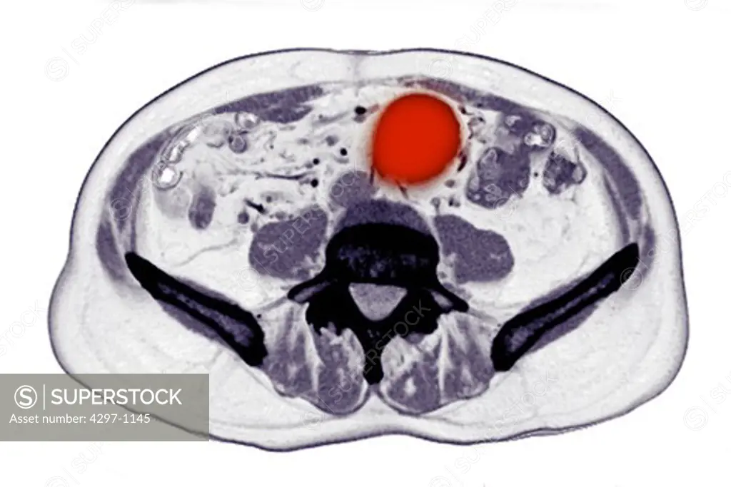 CT scan images showing an abdominal aortic aneurysm which developed between the renal arteries and the common iliac arteries