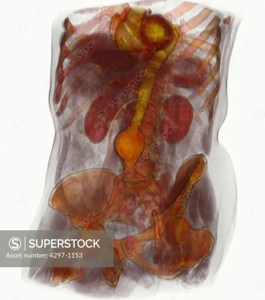CT scan images showing an abdominal aortic aneurysm which developed between the renal arteries and the common iliac arteries