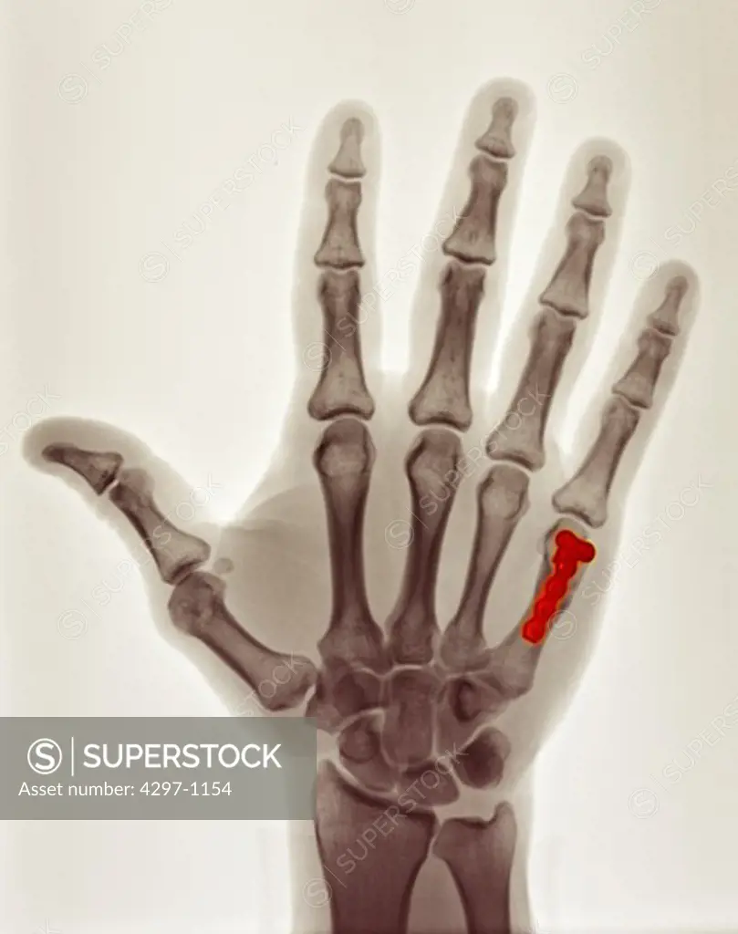 Colorized x-ray of the hand of a 40 year old man showing the surgical repair of a boxer's fracture with a plate and screws