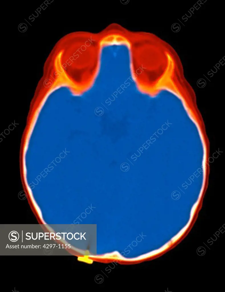 CT scan of a baby who fell backwards and landed with her head on a thumbtack which became embedded in her skull