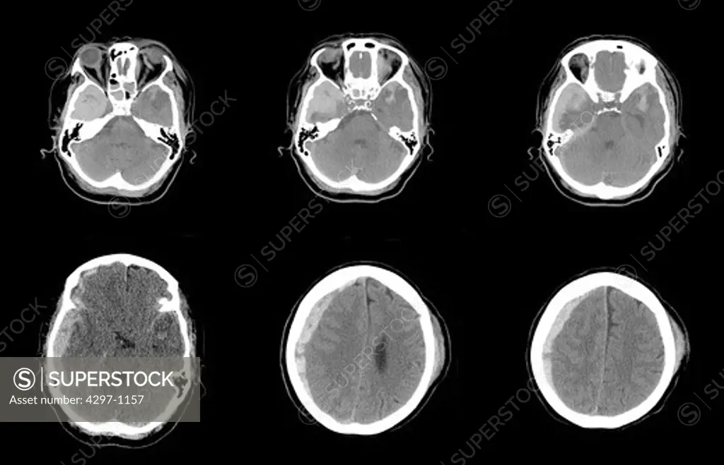 CT scan axial images of a 67 year old woman who fell, hitting the left side of her head