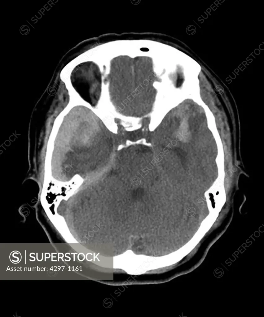 CT scan of a 67 year old woman who fell, hitting the left side of her head
