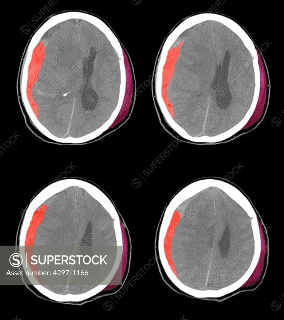 CT scan of a 67 year old woman who fell, hitting the left side of her head
