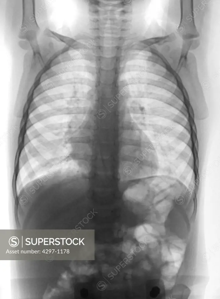 Chest x-ray of a 2 year old boy showing right middle lobe pneumonia