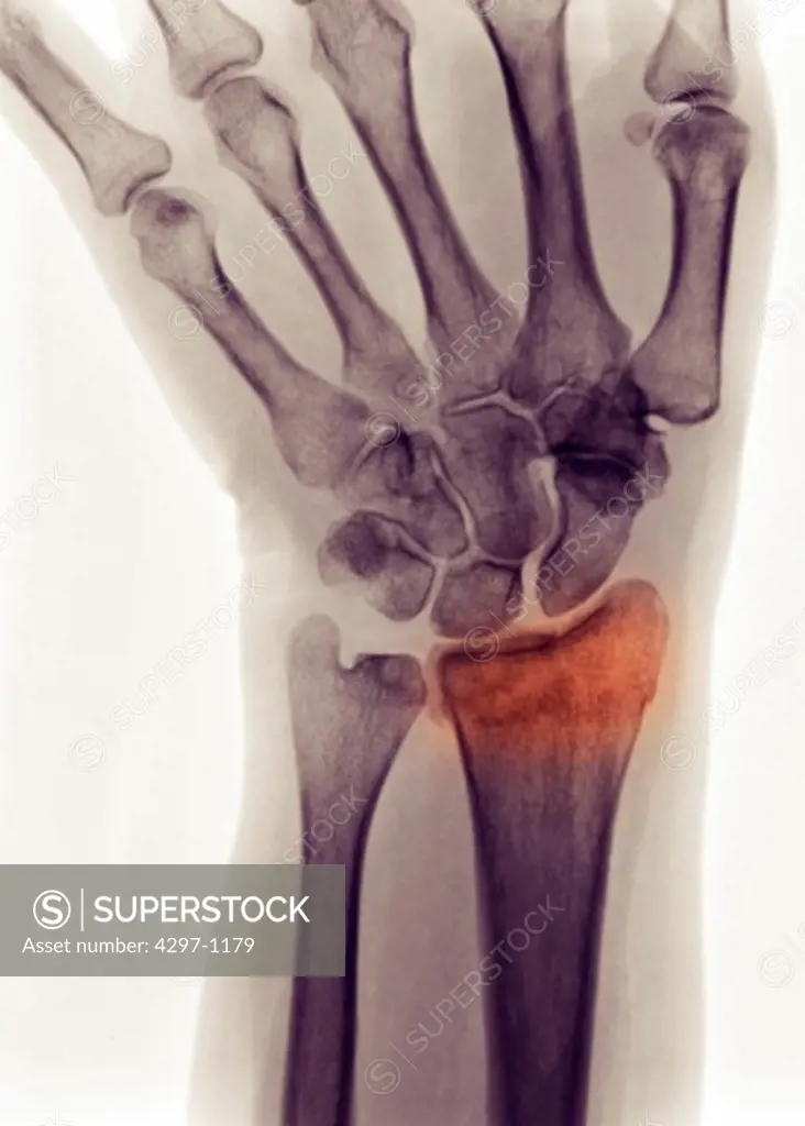 Colorized x-ray showing a distal radius fracture in a 54 year old woman who fell