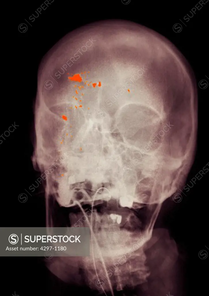 Colorized x-ray of the skull showing a gunshot wound to the head. The patient has been intubated to assist in breathing