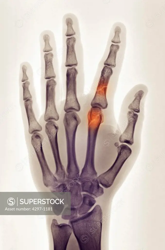 Colorized x-ray of the hand of a 30 year old man showing fractures of the index finger proximal phalanx and metacarpal