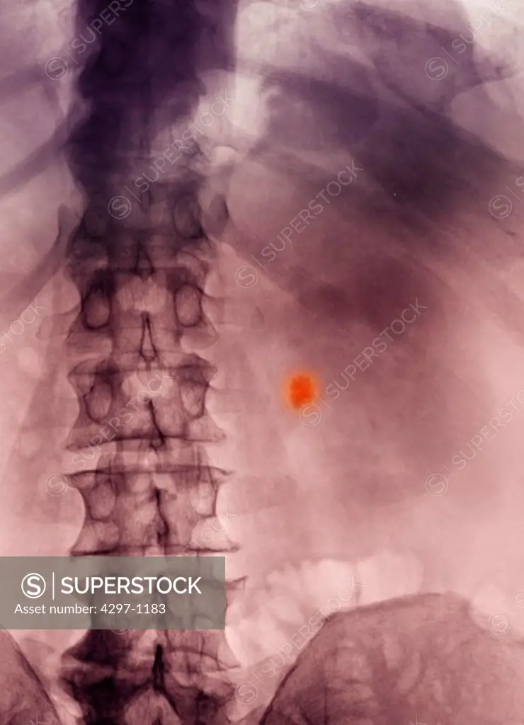 Colorized x-ray of the abdomen of a 70 year old man showing a kidney stone