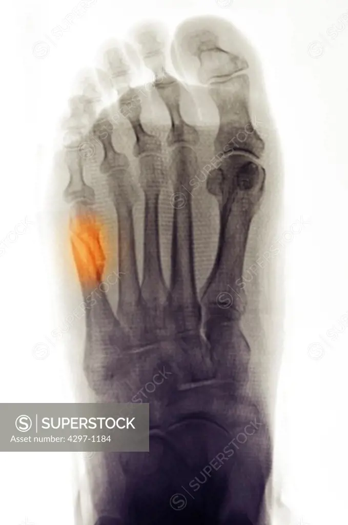 Colorized foot x-ray showing a fifth metatarsal fracture in a 79 year old woman