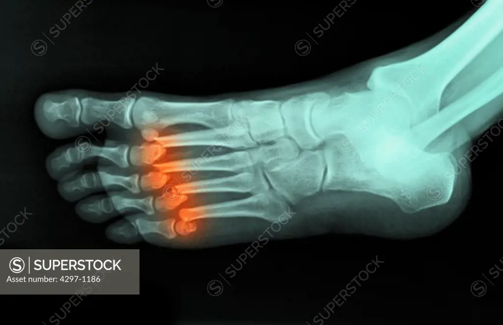 Colorized x-ray of the foot of a 37 year old man showing fractured metatarsals. This person had his foot run over by a vehicle