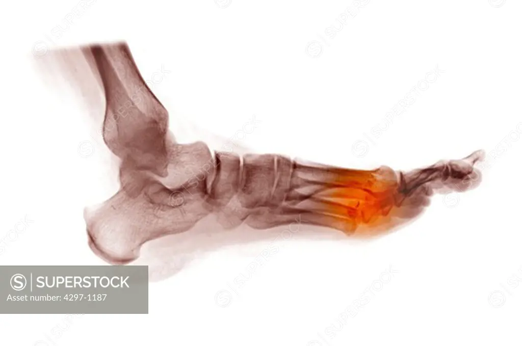 Colorized x-ray of the foot of a 37 year old man showing fractured metatarsals. This person had his foot run over by a vehicle