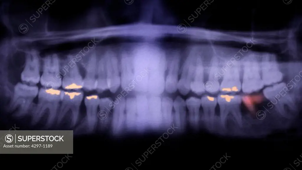 Colorized panorex x-ray showing dental fillings and a decayed tooth