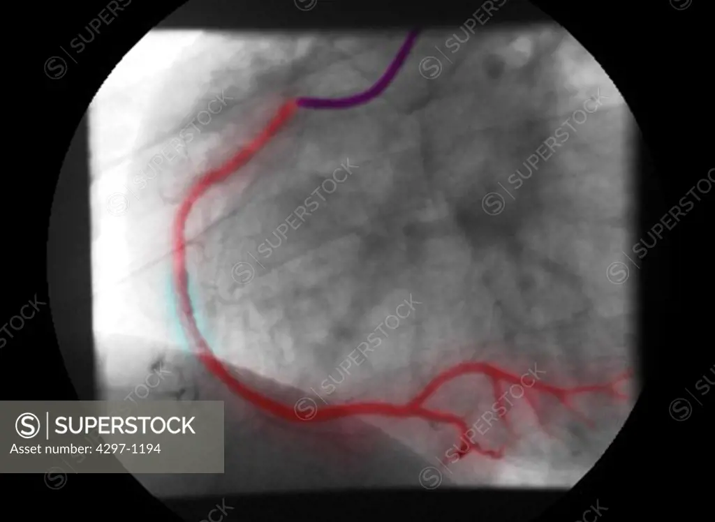 Balloon angioplasty of the coronary arteries