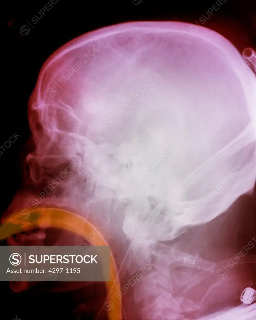 Colorized lateral skull x-ray of a 47 year old man who sustained a head injury in a motor vehicle accident and was intubated