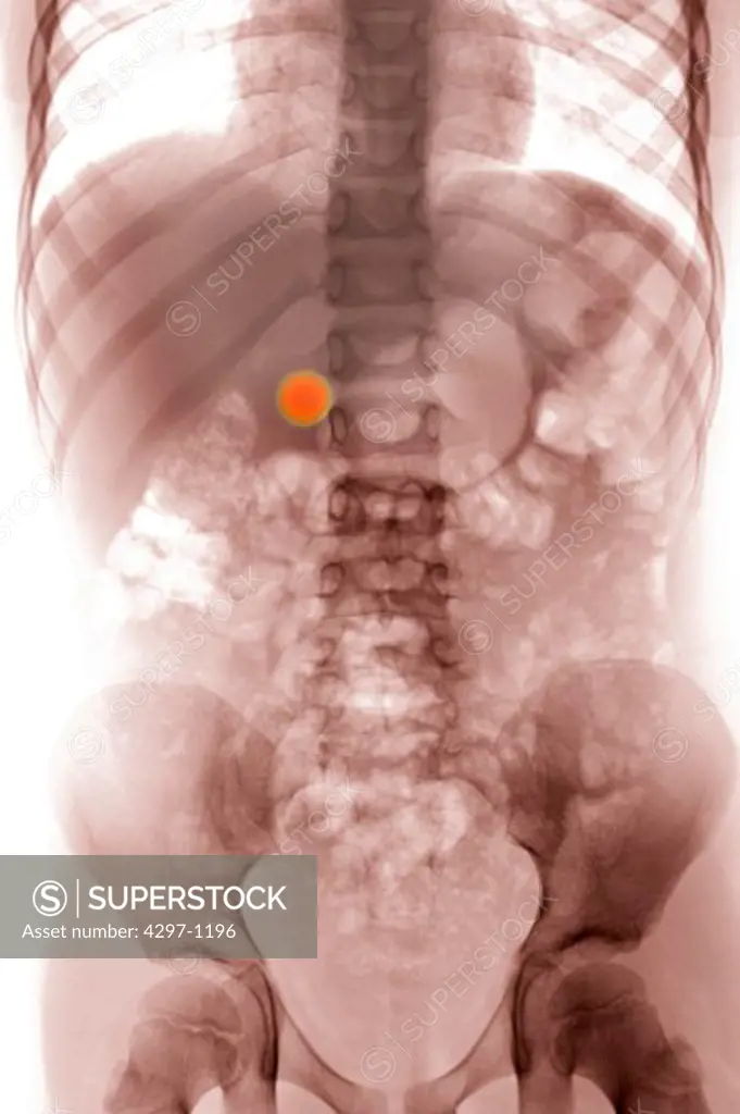 Colorized x-ray of the abdomen of a 6 year old boy who swallowed a marble
