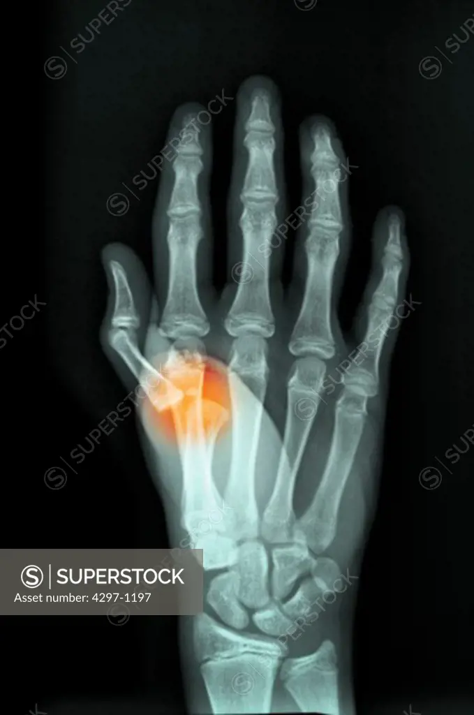 Colorized x-ray of the hand of a 16 year old boy who dislocated his thumb at the