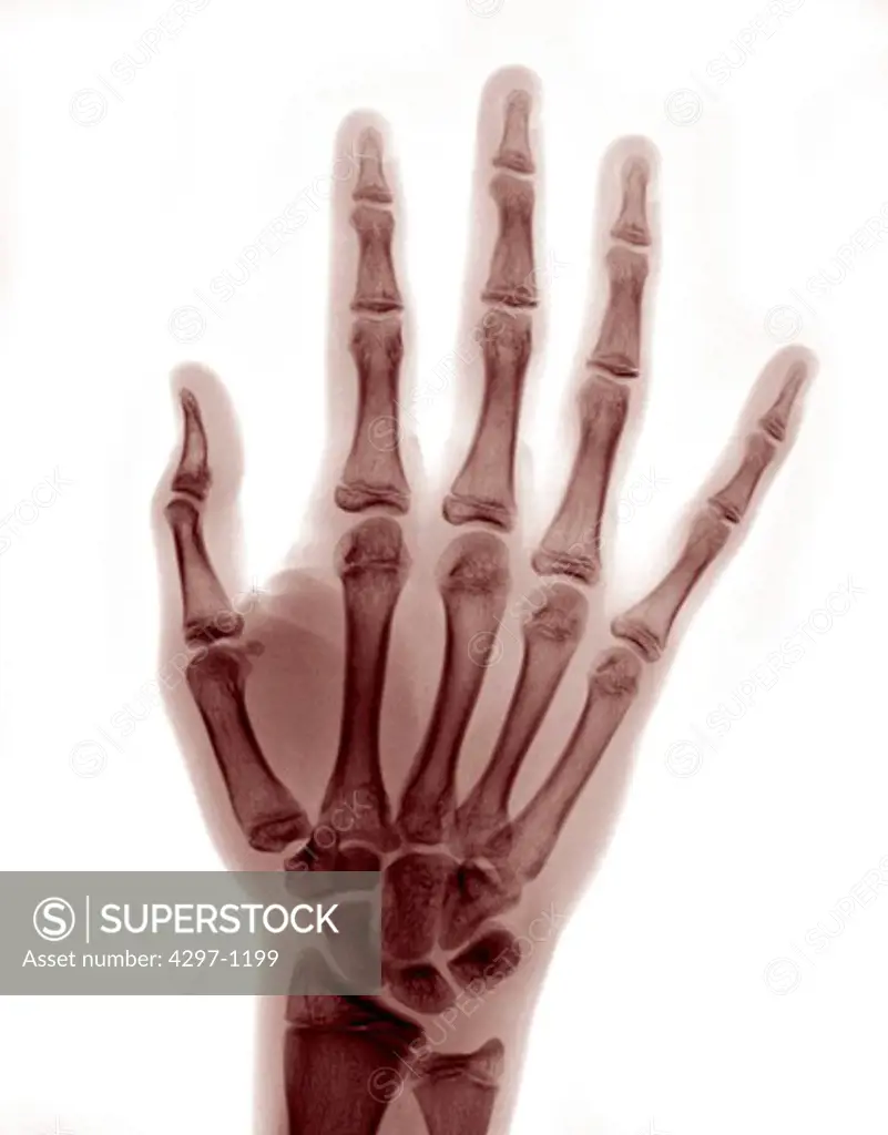 Colorized x-ray of the hand of a 16 year old boy who dislocated his thumb at the metacarpal phalangeal joint