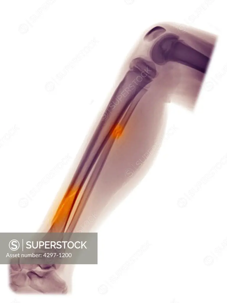 Colorized x-ray of the lower leg of an 8 year old girl showing fractures of the tibia and fibula