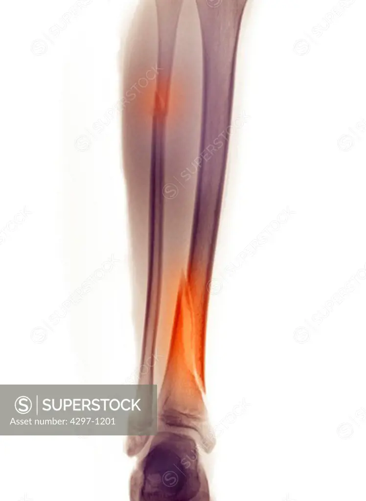 Colorized x-ray of the lower leg of an 8 year old girl showing fractures of the tibia and fibula