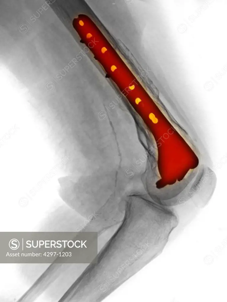 Knee x-ray of a 56 year old woman who had surgery to repair a fracture of the distal femur