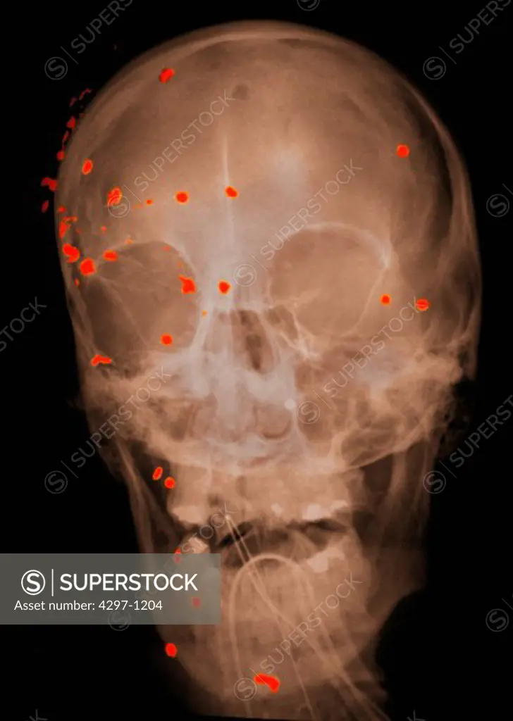 Head x-ray of a 53 year old man with gunshot wounds