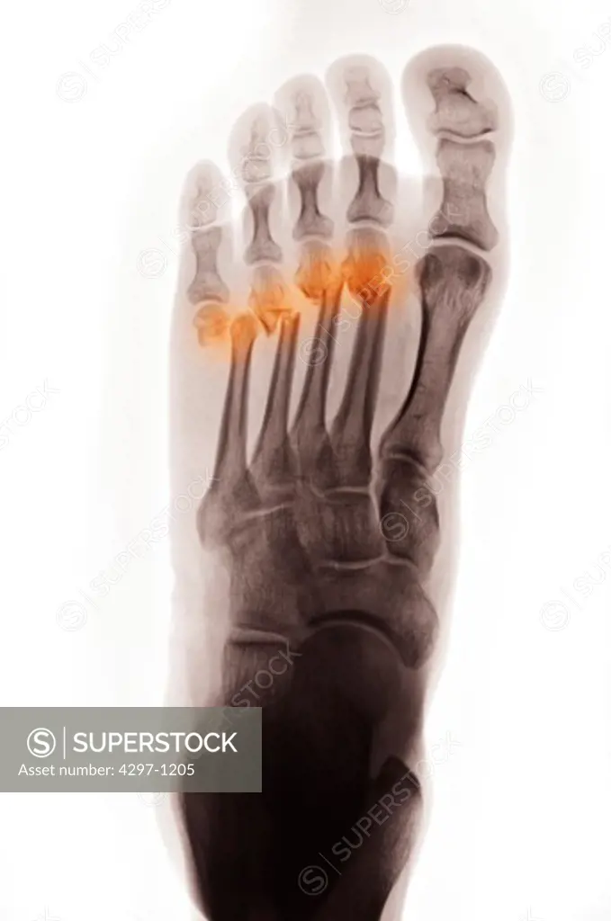 X-ray showing metatarsal fractures in a 37 year old woman