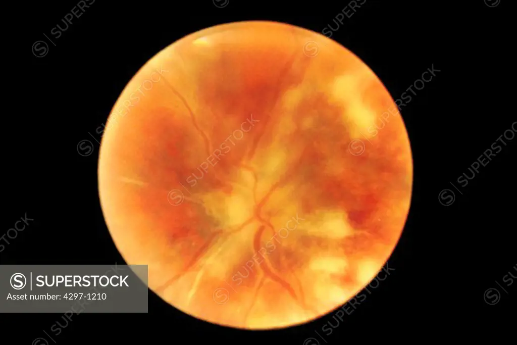 Fundus photograph of the retina of the eye of an AIDS patient with chorioretinitis