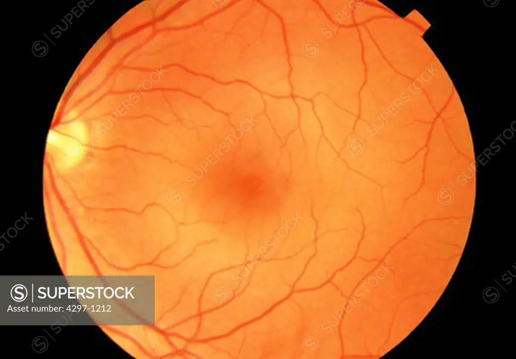 Fundus photograph showing a normal retina