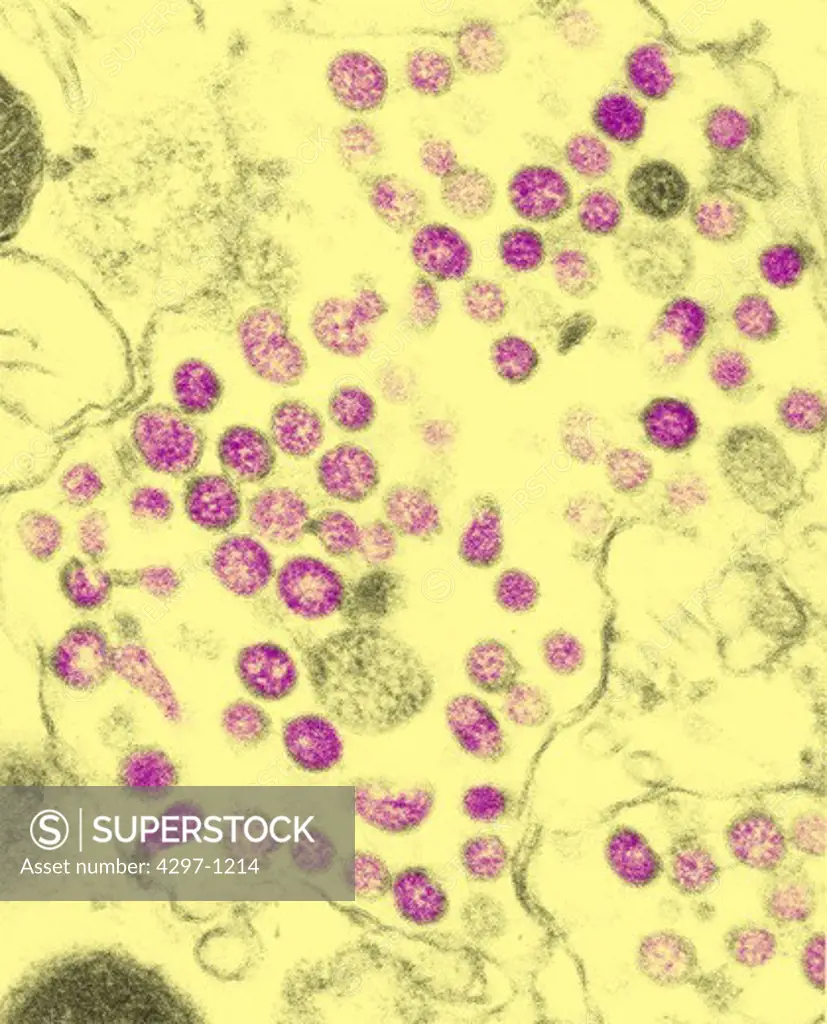 TEM image of coronavirus, the causative agent of SARS