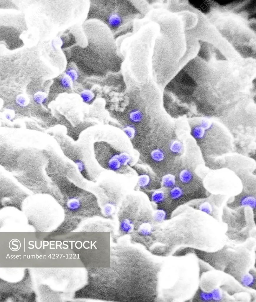 Scanning electron micrograph of human immunodeficiency virus (HIV), grown in cultured lymphocytes. Virions are seen as small spheres on the surface of the cells