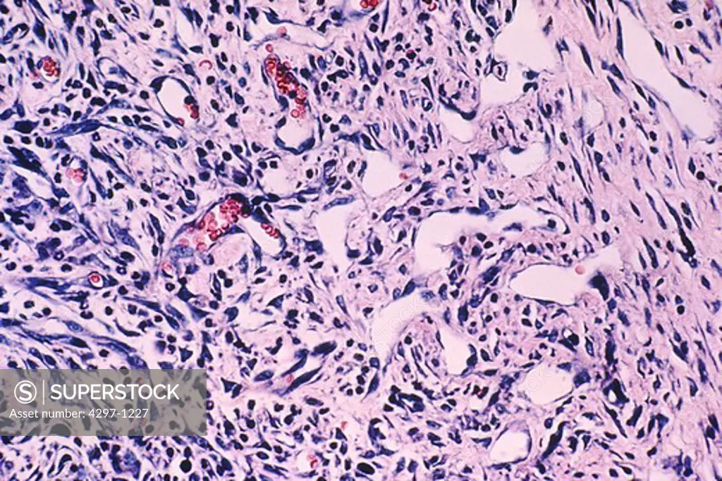 Magnified view of skin cells with Kaposi's sarcoma histology