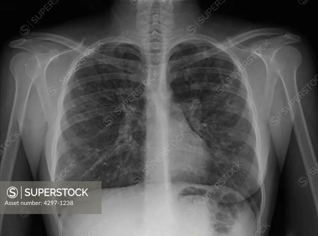 Chest x-ray of a 28 year old woman with cystic fibrosis showing bronchiectasis