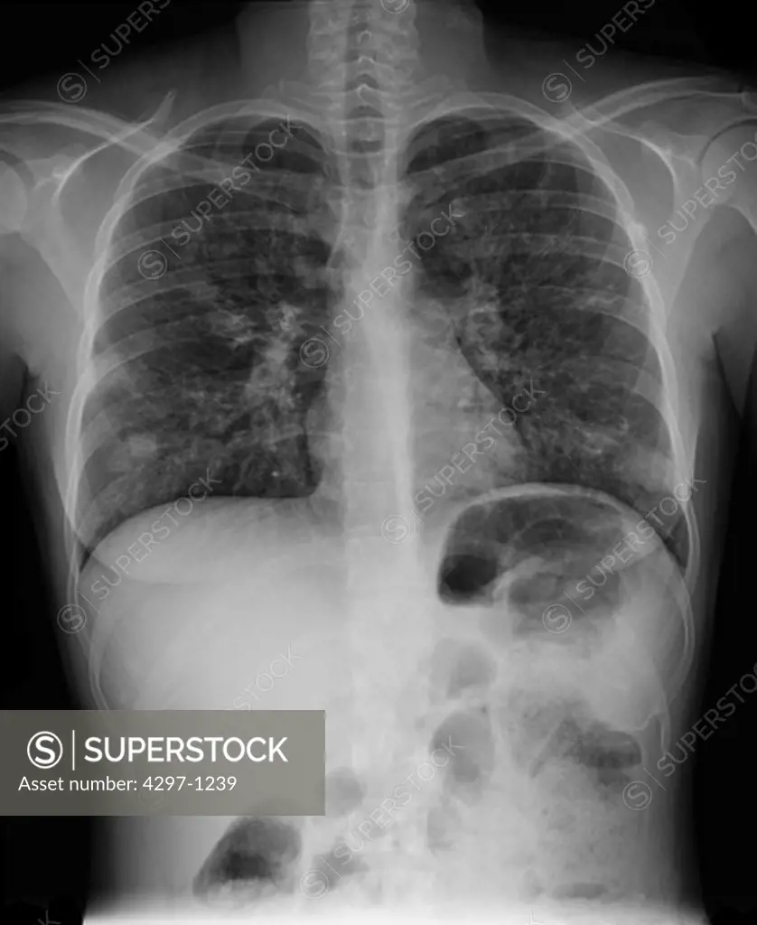 Chest x-ray of a 28 year old woman with cystic fibrosis showing bronchiectasis