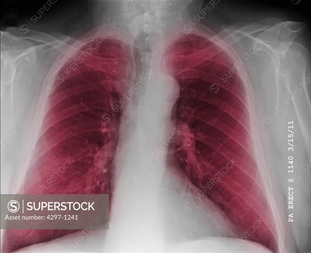 Chest x-ray of a 76 year old man with COPD, chronic obstructive pulmonary disease
